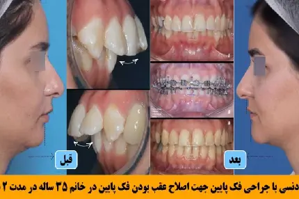 از فاصله دندونها تا لبخند کامل؛ عکسهای ارتودنسی دندان فاصلهدار بیماران دکتر سلیمانی