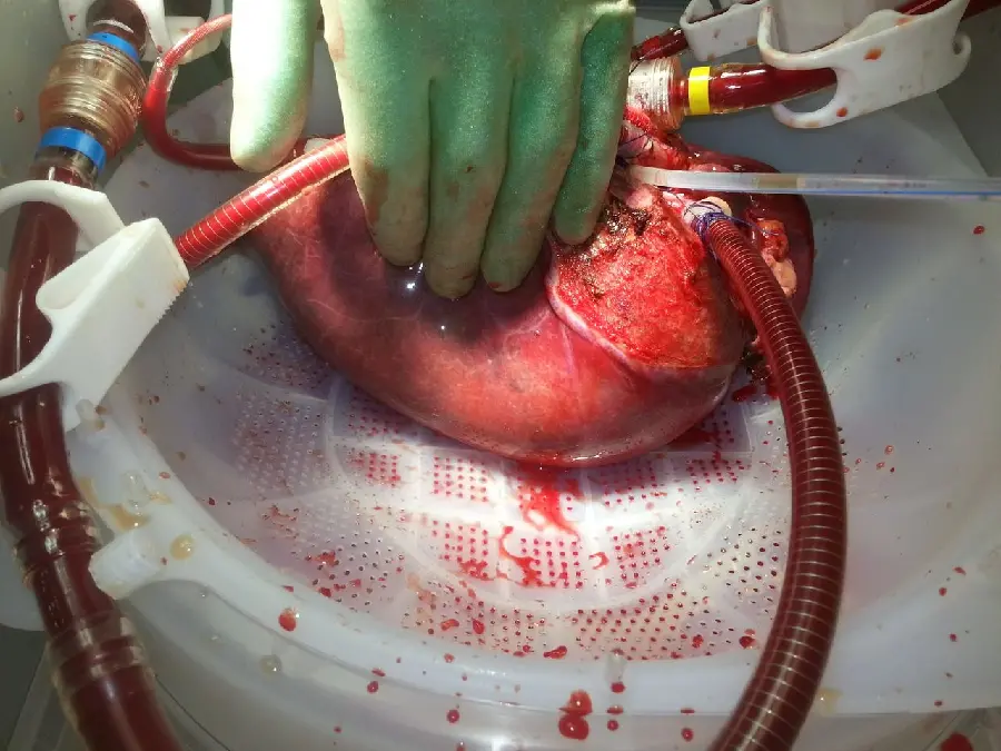 عکس جراحی کبد انسان توسط پزشک جراح