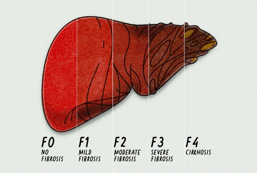 عکس درجه بندی کبد چرب انسان