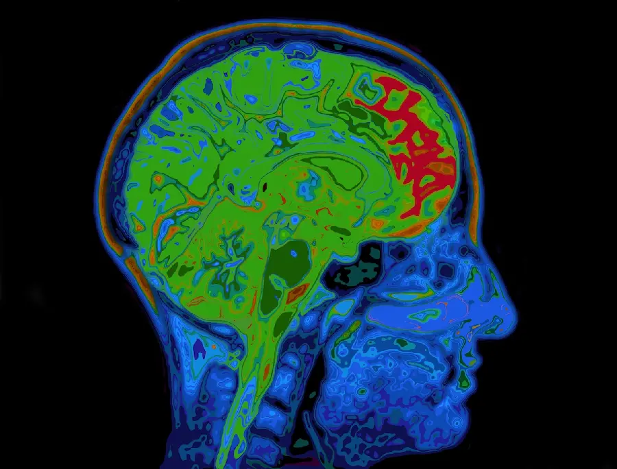 تصویر mri مغز سالم