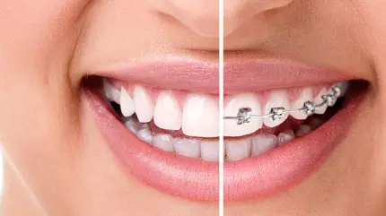 عکس ارتودنسی با کیفیت بالا برای پوستر مطب های دندانپزشک ها