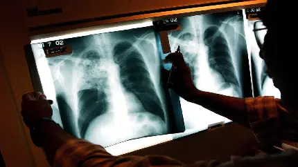عکس ریه انسان در رادیولوژی