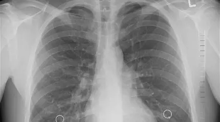 دانلود عکس رادیولوژی ریه و دستگاه تنفسی انسان