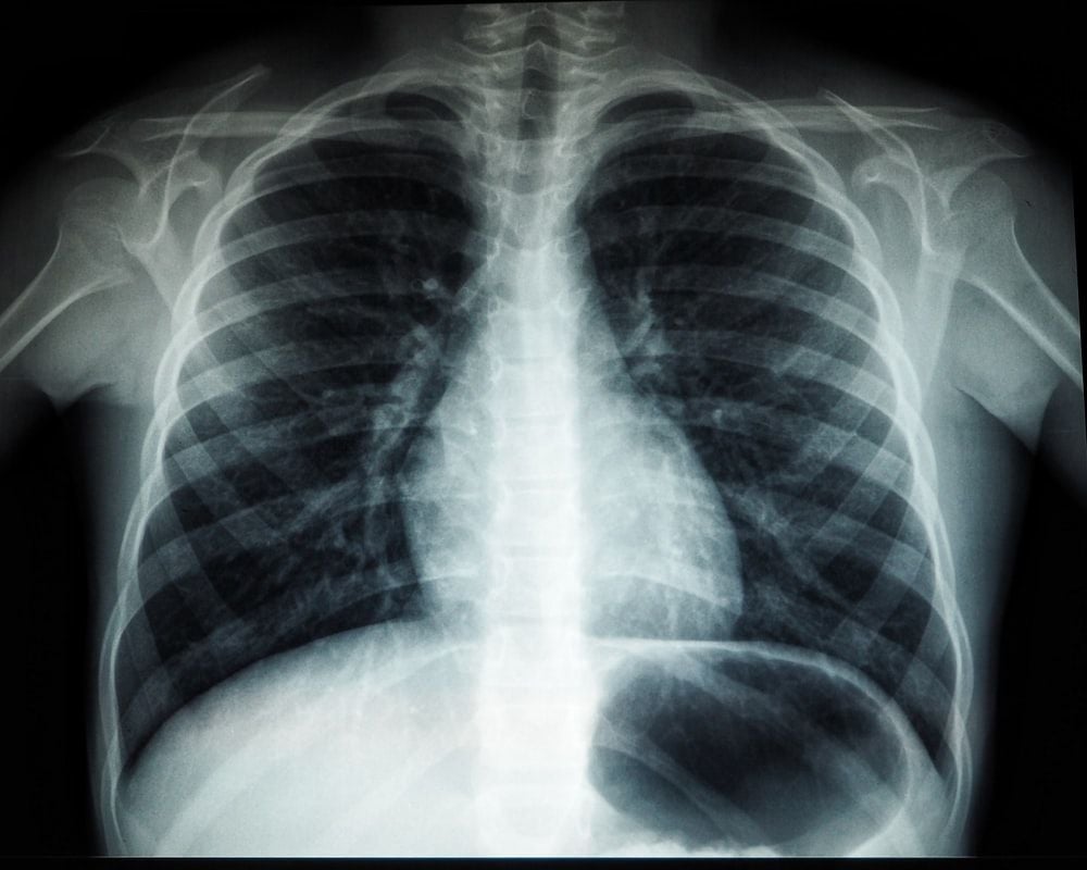 عکس دقیق رادیولوژی قفسه سینه برای علاقمندان پزشکی