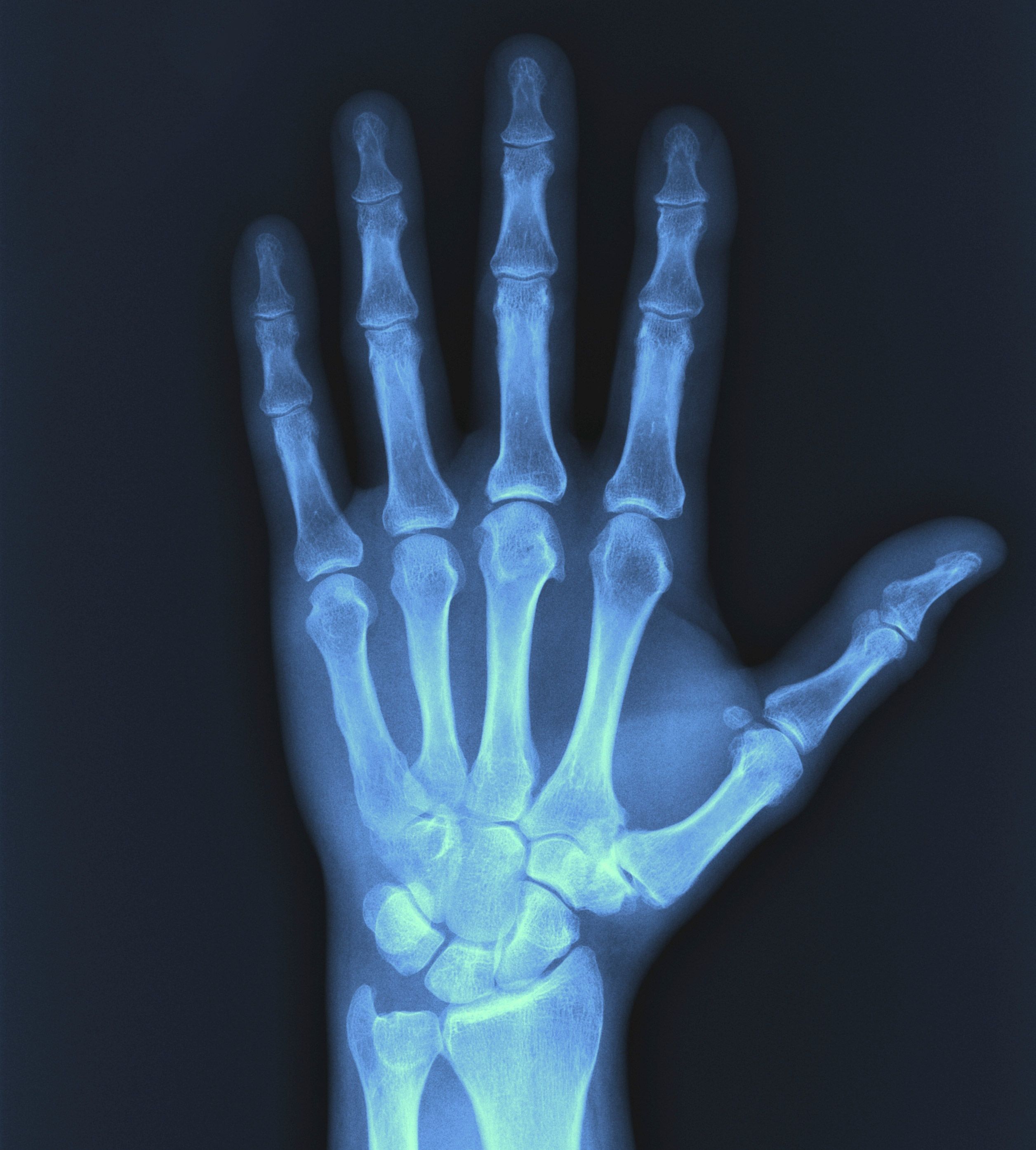 عکس استوک رادیولوژی دست انسان با جزئیات چشمگیر