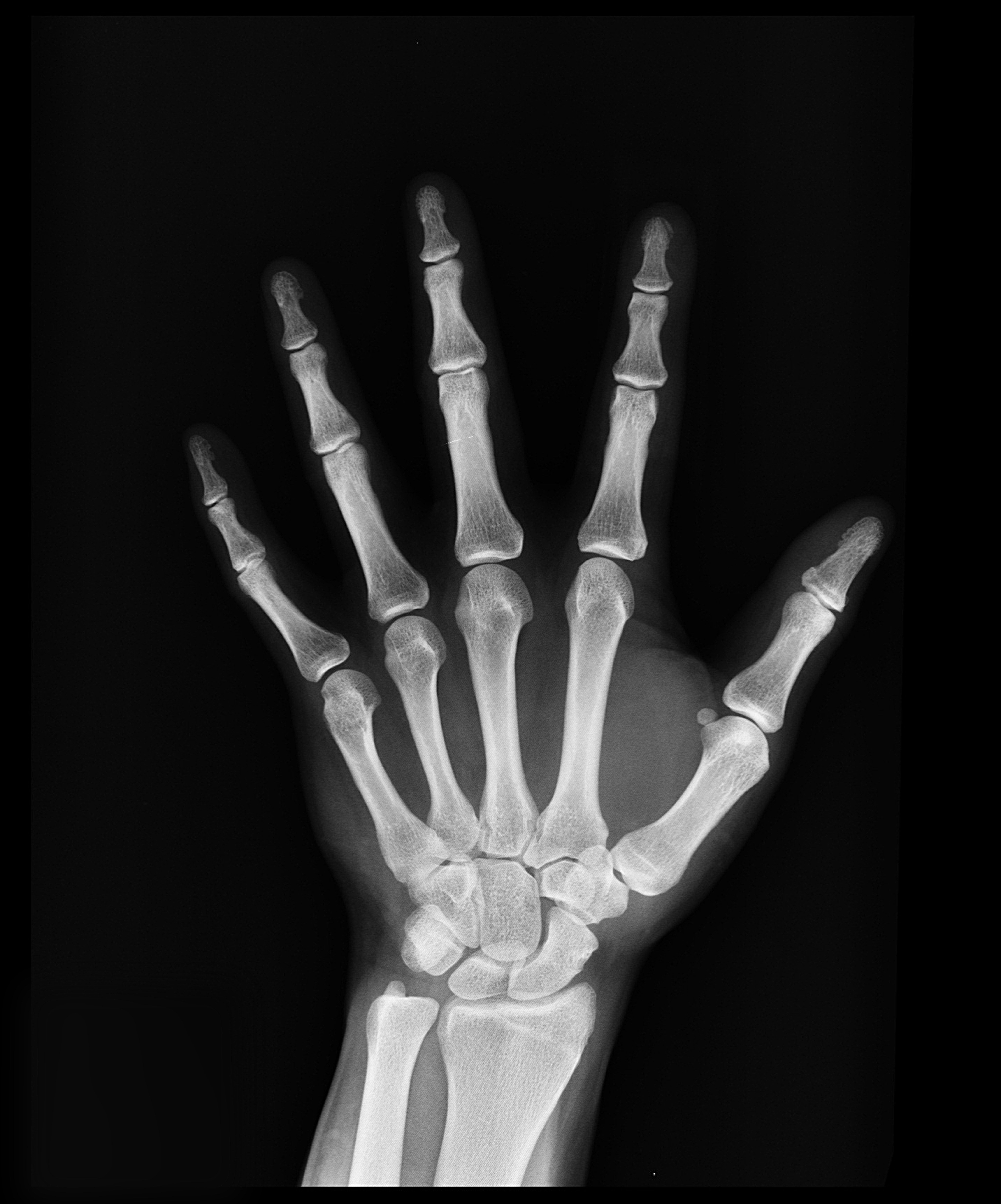 رادیولوژی دست چپ انسان برای شناخت استخوان ها