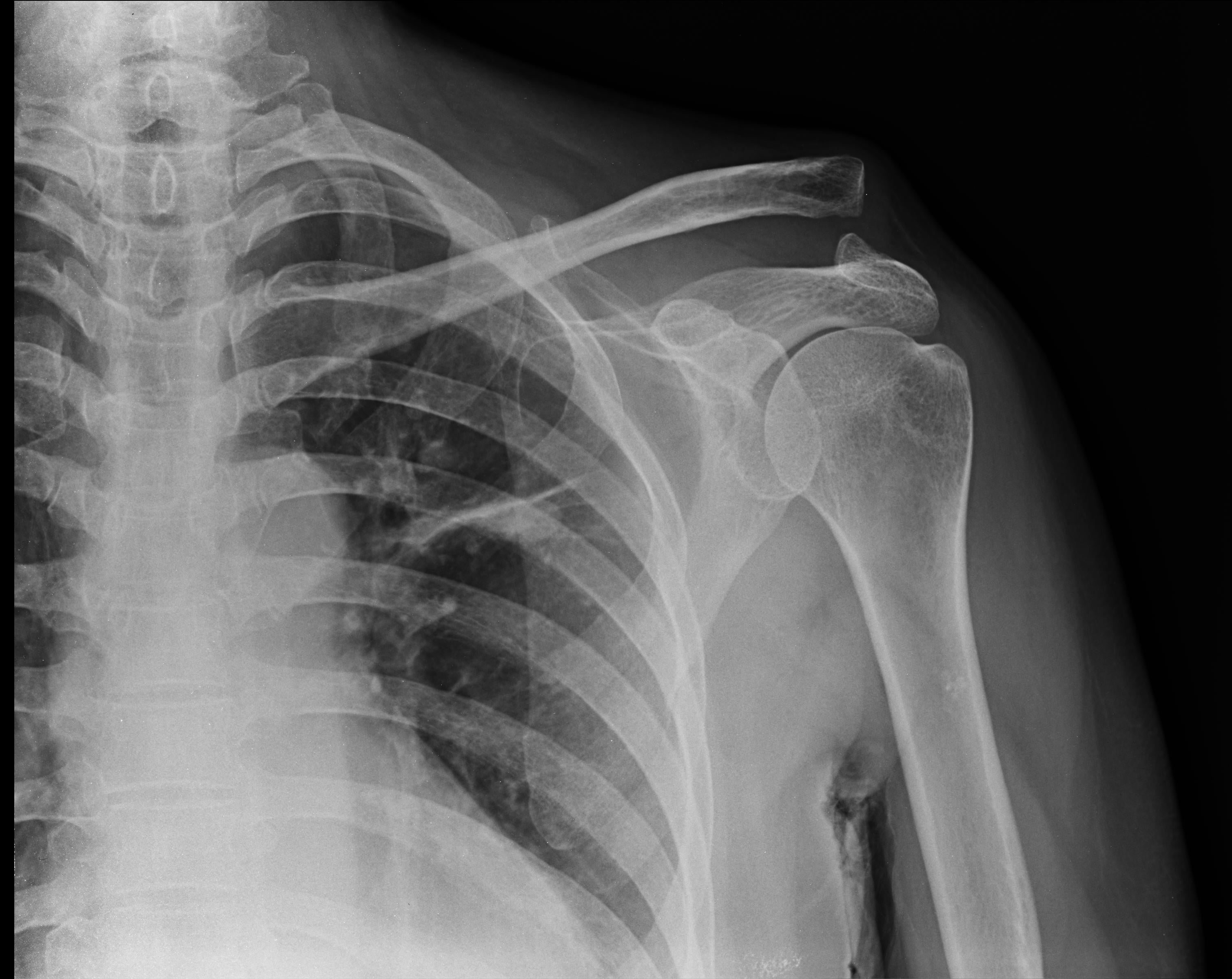 در رفتگی استخوان پشتی کتف در عکس رادیولوژی 1401