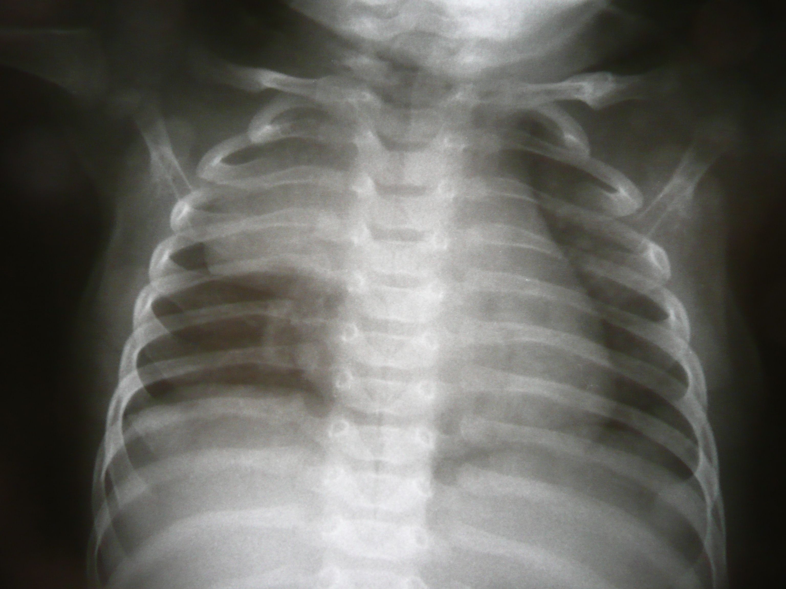 رادیولوژی ریه ها و قفسه سینه در فرمت JPG کاملا رایگان