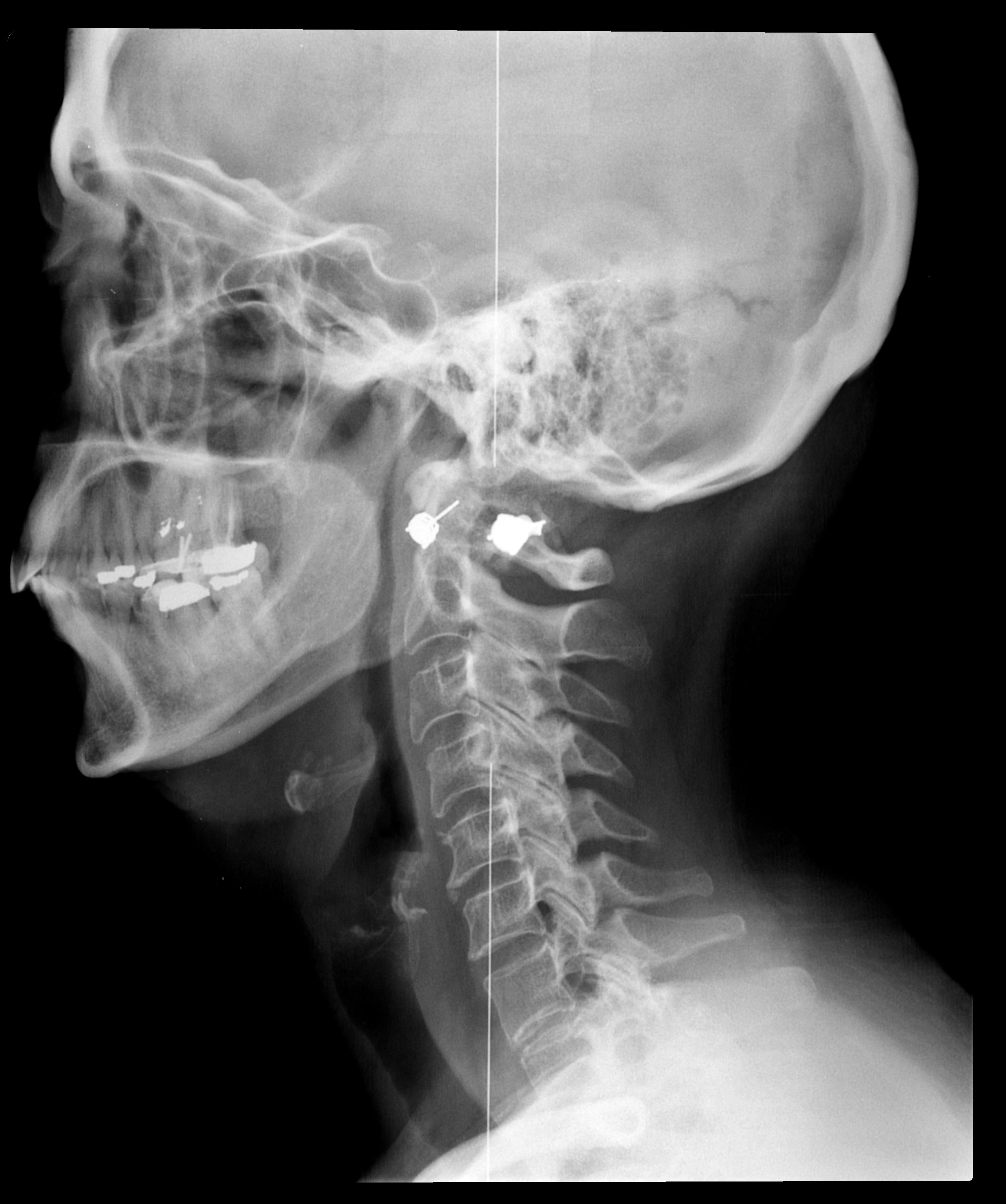 عکس رادیولوژی سیاه سفید ناحیه سر و گردن برای تحقیق