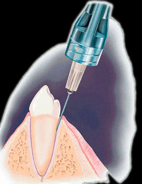 تصویر دور بری شده پی ان جی png دندان درحال آمپول زدن 
