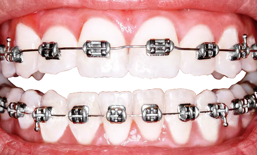 عکس بدون بک گراند و زمینه ارتودنسی دندان ویژه با فرمت png