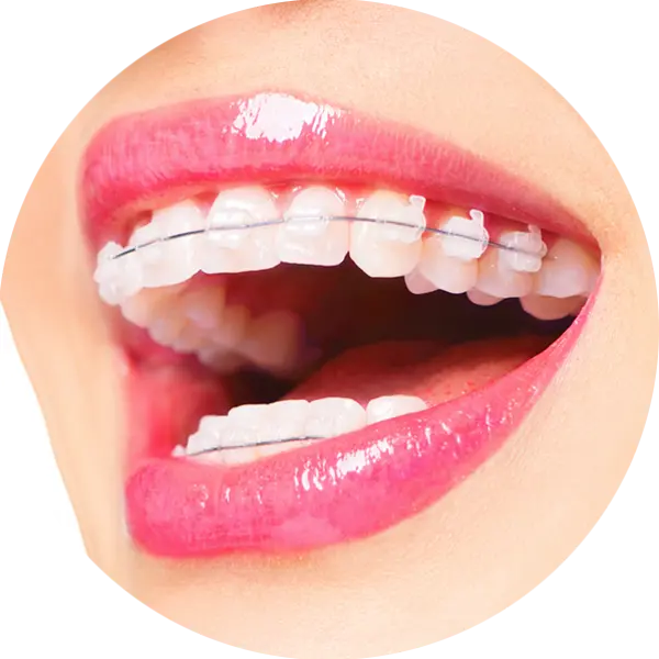 PNG عالی ارتودنسی نامرئی دندان برای استفاده در فتوشاپ