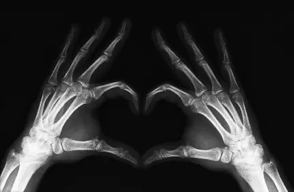 دانلود عکس رادیولوژی استخوان های دست سالم با ژست قلبی 