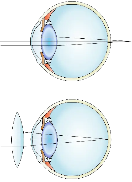 فایل شفاف اختلال دوربینی در بینایی سنجی با کیفیت اچ دی