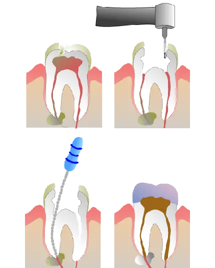 تصویر png و دور بری شده مراحل ایمپلنت و کاشت دندان 