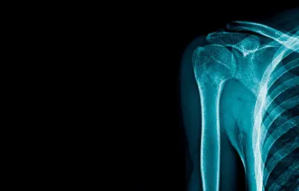 بهترین تصویر رادیولوژی استخوان بازو با کیفیت فول اچ دی